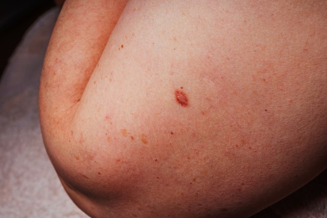 Na telu vam se pojavljuju crvene tačkice? Evo da li su opasne